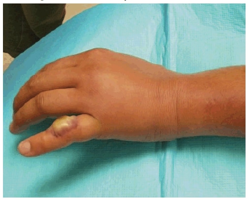 The figure shows a nodule caused by orf virus infection after contact with a lamb being sacrificed for the Muslim holiday Eid al-Adha in Massachusetts in 2010. Approximately 5 days after infection, a small papular lesion developed, which gradually became swollen and painful. Two weeks later, the lesion was incised and drained at an emergency department; no pus was noted.